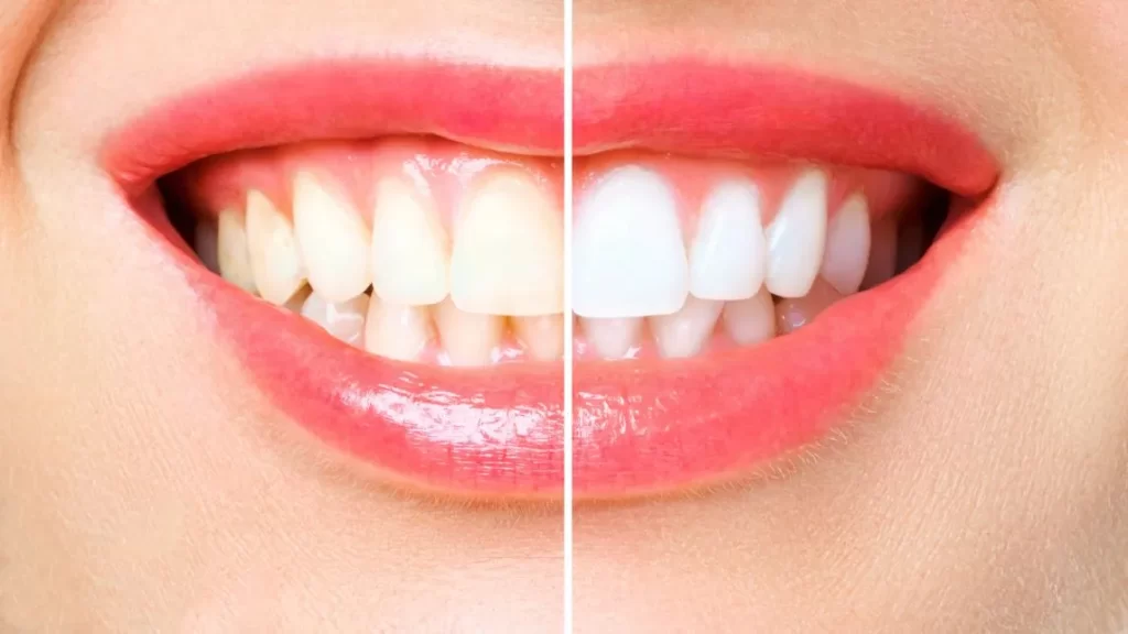 Clareamento Dental no Rio Vermelho - Dra. Daniela Chaoui