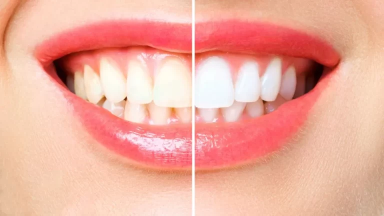 Quanto Custa um Clareamento Dental? Tipos e Valores