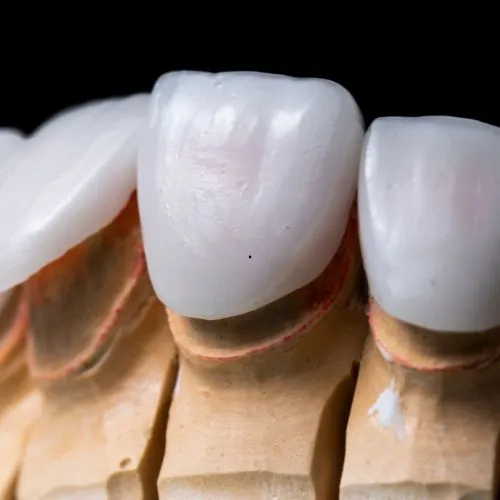 Facetas em cerâmica no Rio Vermelho para estética e harmonização do sorriso