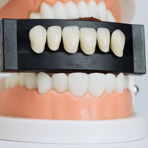 Facetas em resina composta no Rio Vermelho para harmonização do sorriso