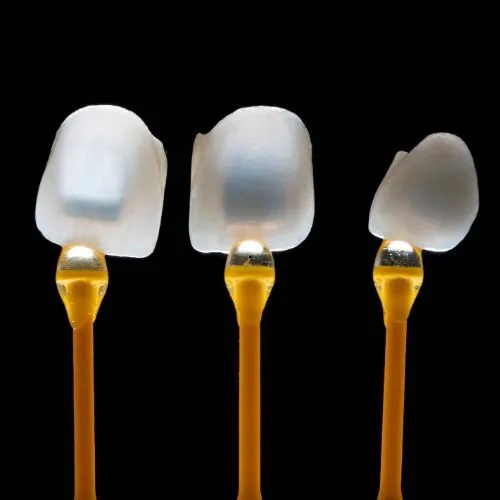 Lentes de contato dental no Rio Vermelho para harmonização do sorriso