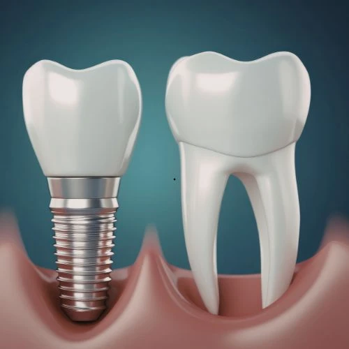 Pino e coroa dentária no Rio Vermelho para reabilitação oral