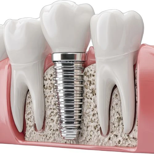 Prótese fixa em dente no Rio Vermelho para reabilitação oral
