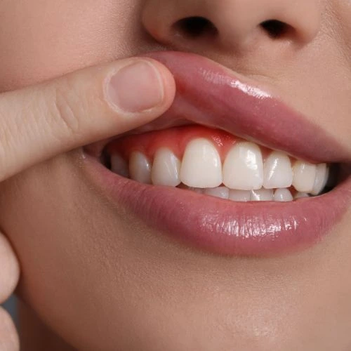 Sorriso harmonizado com gengivoplastia estética no Rio Vermelho