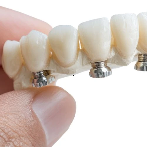 Indicação para coroas dentárias em porcelana no Rio Vermelho