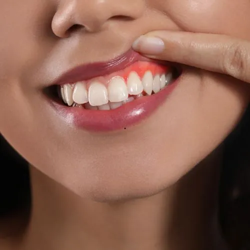 Indicação para gengivoplastia estética no Rio Vermelho