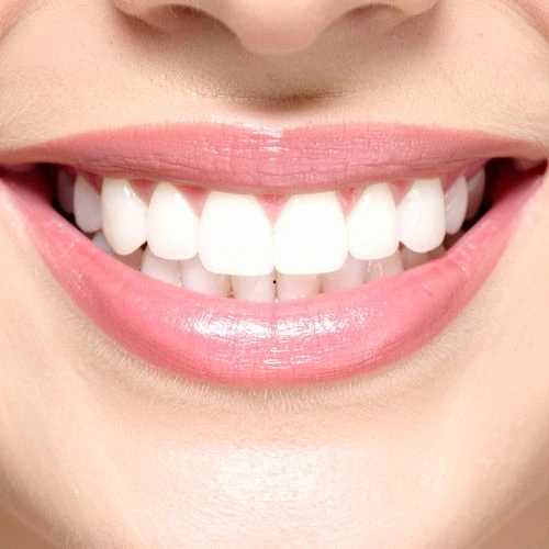 Indicação para lentes de contato dental no Rio Vermelho
