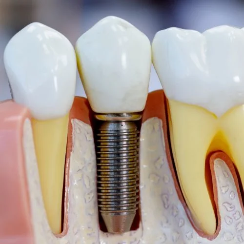 Indicação para pino e coroa dentária no Rio Vermelho