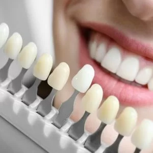 Etapas do clareamento dental no Rio Vermelho