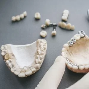 Etapas do tratamento com coroas dentárias em porcelana no Rio Vermelho