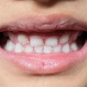 Etapas da gengivoplastia estética no Rio Vermelho