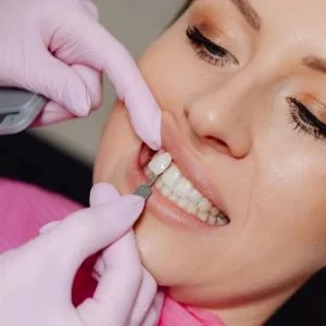 Etapas do tratamento com lentes de contato dental no Rio Vermelho