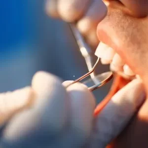 Etapas da limpeza e profilaxia dental no Rio Vermelho