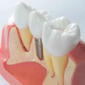 Etapas do tratamento com prótese fixa em dente no Rio Vermelho